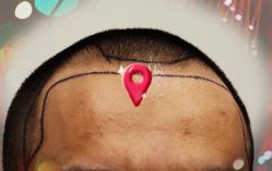 -大麦微针植发全国连锁