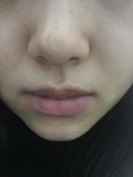 -成都苗方清颜专业祛痘