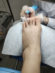 -派恩宜灰指甲鸡眼嵌甲手足癣