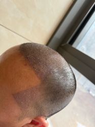 -碧莲盛·不剃发植发