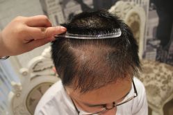 点击看大图 -大麦微针植发丨全国连锁