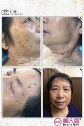-美人痣全国连锁