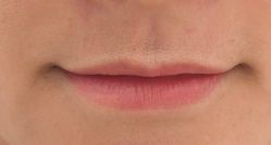 体验前-深圳美莱医疗美容医院