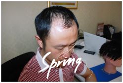 体验后-大麦微针植发全国连锁