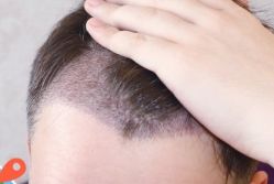 -大麦微针植发丨全国连锁