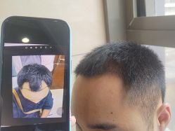 点击看大图 -碧莲盛·不剃发植发