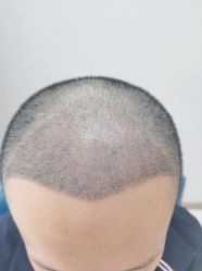 -大麦微针植发丨全国连锁
