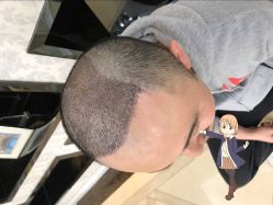 -大麦微针植发丨全国连锁