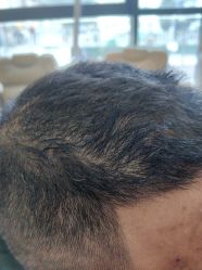 -碧莲盛·不剃发植发