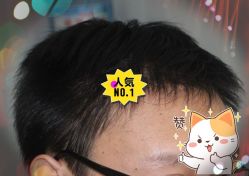 -大麦微针植发全国连锁