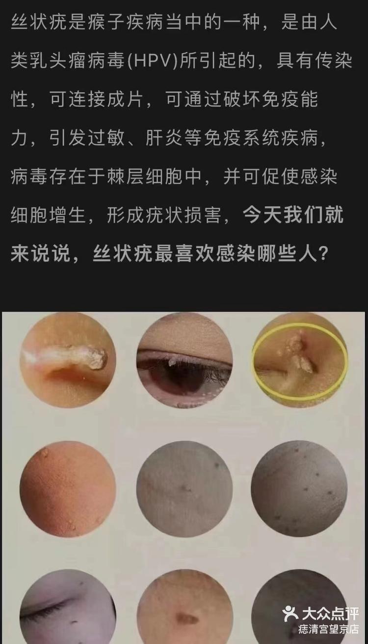 疣有几种类型图片图片