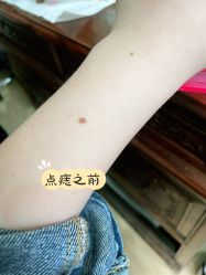 点击看大图 -痣缘宫