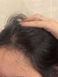 -碧莲盛·不剃发植发