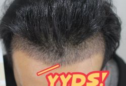 -大麦微针植发丨全国连锁