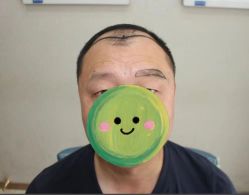 点击看大图 -大麦微针植发丨全国连锁