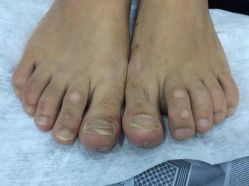 -德哥灰指甲脚气甲沟炎跖疣护理