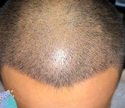 -大麦微针植发丨全国连锁