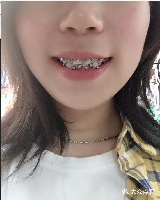 做金属矫正你会后悔吗？