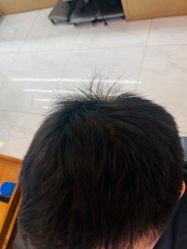 -大麦微针植发丨全国连锁