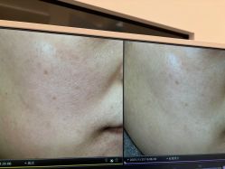 -苑苑vbeauty科技美容SPA