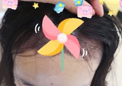 -大麦微针植发全国连锁