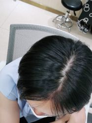 点击看大图 -碧莲盛·不剃发植发