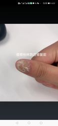 -德哥灰指甲脚气甲沟炎跖疣护理