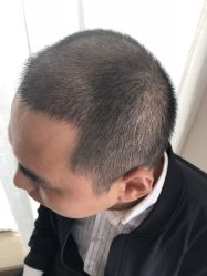 点击看大图 -大麦微针植发丨全国连锁