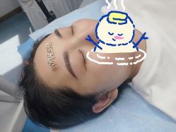 体验后-郡艺医疗美容·微整·眼鼻吸脂