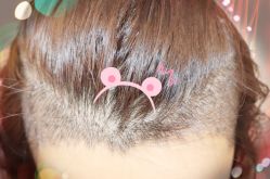 -大麦微针植发全国连锁