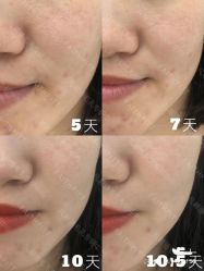 -凡碧诗毛孔清洁收细