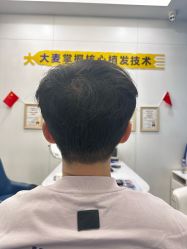 -大麦微针植发全国连锁