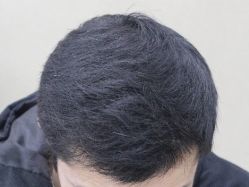 -大麦微针植发丨全国连锁