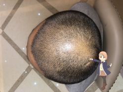 -大麦微针植发丨全国连锁