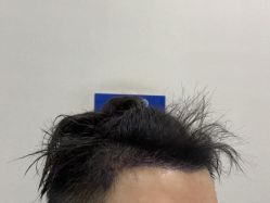 -碧莲盛·不剃发植发