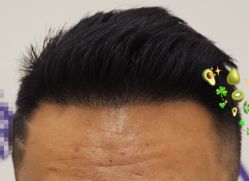 -大麦微针植发全国连锁