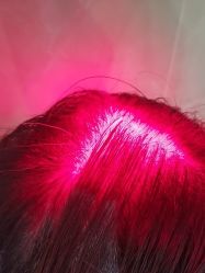 -碧莲盛·不剃发植发