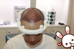 -大麦微针植发丨全国连锁