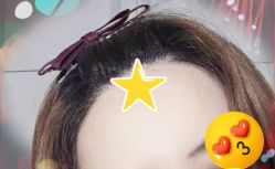 -大麦微针植发全国连锁