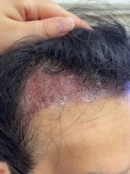 -大麦微针植发丨全国连锁