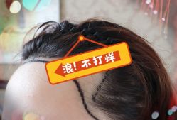 -大麦微针植发全国连锁