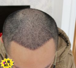 -大麦微针植发丨全国连锁