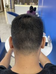 体验后-大麦微针植发全国连锁