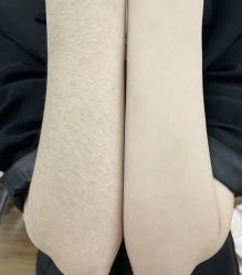 -薇兰专业脱毛连锁机构