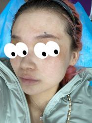 体验前-麗宫轻医美·问题肌肤管理中心