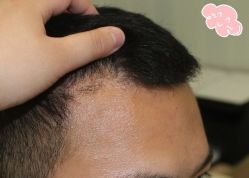 -大麦微针植发丨全国连锁