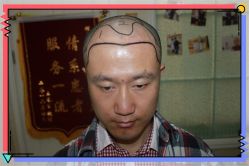 -大麦微针植发全国连锁