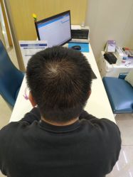 -大麦微针植发全国连锁