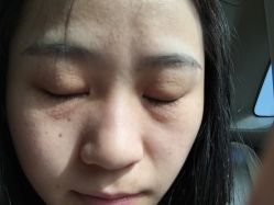 -爱莎扁平疣·汗管瘤·斑痣中心
