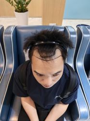 -大麦微针植发丨全国连锁